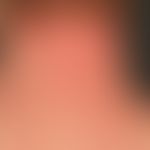 Eczema, atopic: disseminated clinical picture with chronically stationary, blurred, itchy and pai...