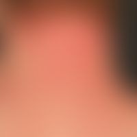 Ekzem, atopisches: disseminiertes Krankheitsbild mit&nbsp;chronisch stationären, unscharf begrenz...