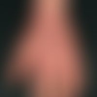 Hand eczema atopic: long-term atopic eczema with variable course, the skin on both backs of the h...