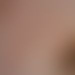 Erythema chronicum migrans: unscharf begrenztes Erythem. Im Zentrum gerötete Narbe nach Zeckensti...