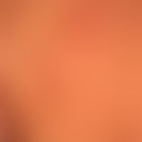 Erythema chronicum migrans: anular erythema that has been developing for several weeks, completel...