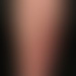 Erythema nodosum: akute, großflächige schmerzhafte indurierte Plaque.
