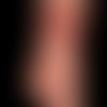 Erythema nodosum:&nbsp;akute, multiple schmerzhafte indurierte Plaques und Knoten. Begleitende Ar...
