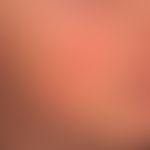 Erythema perstans faciei: symmetrische, wechselhafte Rötung (geht manchmall mit einem Spannungsfü...