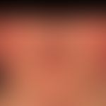 Erythema perstans faciei:&nbsp;symmetrische, Rötung beider Wangen. Wird von dem Patienten nicht a...