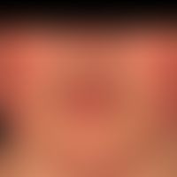 Erythema perstans faciei:&nbsp;symmetrische, Rötung beider Wangen. Wird von dem Patienten nicht a...