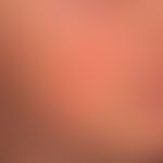 Erythema perstans faciei:&nbsp;symmetrische, wechselhafte Rötung beider Wangen (hier eingekreist)...