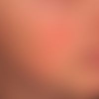 Erythema perstans faciei:&nbsp;symmetrische, wechselhafte Rötung beider Wangen (hier eingekreist)...