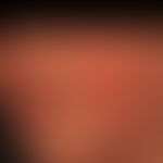 Erythema infectiosum: in cases of moderate feeling of illness, flat, butterfly-shaped redness and...