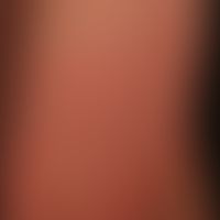 Erythema infectiosum:&nbsp;teils anuläre teils retikuläre Erytheme an der unteren Extremität.&nbsp;

