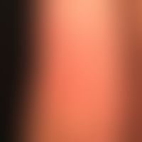 Erythema infectiosum: partly ring-shaped partly garland-like erythema (plaques) on the upper extr...