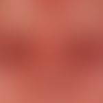 erysipelas. flaming, centrofacially accentuated erythema with overheating and with severe lid ede...
