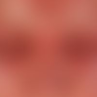 Erysipel: flammendes, zentrofazial akzentuiertes Erythem mit Überwärmung und mit kräftigen Lidöde...