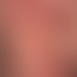 Erythema anulare centrifugum:&nbsp;seit mehreren Monaten bestehendes "wanderndes" anuläres Exanth...