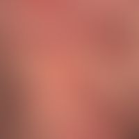 Erythema anulare centrifugum:"migrating" anular exanthema existingsinceseveral months. no itching...