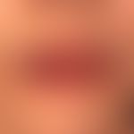 Akute Cheilitis bei Erythema exsudativum mulitforme&nbsp;

