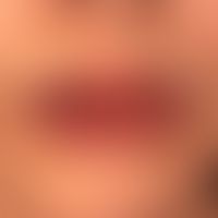 Akute Cheilitis bei Erythema exsudativum mulitforme&nbsp;
