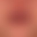 Schwere akute Cheilitis&nbsp;(und Stomatiis) bei Erythema exsudativum multiforme.

