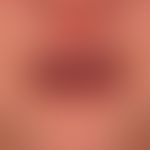 Schwere akute Cheilitis&nbsp;(und Stomatiis) bei Erythema exsudativum multiforme.
