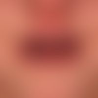 Severe acute cheilitis(and stomatiis) in erythema exsudativum multiforme.
