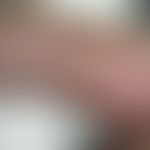 Schweres großflächiges bullöses Erysipel
