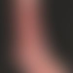 Large circumferentialulcer of the lower leg and back of the foot in a patient with CVI after seve...