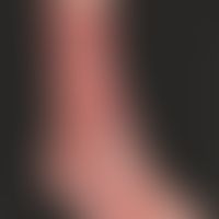 Large circumferentialulcer of the lower leg and back of the foot in a patient with CVI after seve...