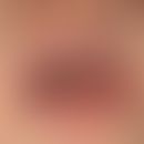 Gingivostomatitis herpetica.&nbsp;Seit 3 Tagen bestehendes Krankheitbild mit Fieber regionaler Ly...