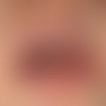 Gingivostomatitis herpetica.&nbsp;Seit 3 Tagen bestehendes Krankheitbild mit Fieber regionaler Ly...