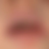 Gingivostomatitis herpetica.&nbsp;Seit 3 Tagen bestehendes Krankheitbild mit Fieber regionaler Ly...