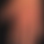 Granuloma anulare erythematöser Typ. &nbsp;Wenig indurierte, randbetonte, rot-braune Plaque bei a...