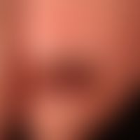 Nagelhämatom: nach gut erinnerlichem, etwa 3 Wochen zurückliegendem Trauma, akute Rotfärbung des ...