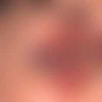 Raccoon-sign: Not quite fresh periorbital hematoma.
