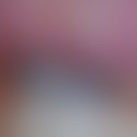 DD Hutchinson's sign: not quite fresh, bluish translucent subungual hematoma with hemorrhaging in...