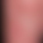 Karzinom der Haut:&nbsp; Karzinombildung auf&nbsp;einem vorbestehenden, chronischen arteriellen U...