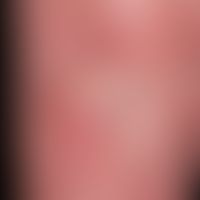 Karzinom der Haut:&nbsp; Karzinombildung auf&nbsp;einem vorbestehenden, chronischen arteriellen U...