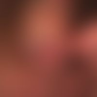 Penis carcinoma: for several months slowly developing, completely painless, firm lump on the inne...