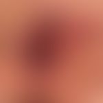 Anal carcinoma: HPV-induced carcinoma of the anal region, partly flat indurated, partly nodular; ...