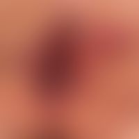 Anal carcinoma: HPV-induced carcinoma of the anal region, partly flat indurated, partly nodular; ...