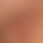 Keloid: seit mehreren Monaten bestehendes zeitweise schmerzendes Narbenkeloid, nach Exzsion einer...