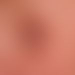 Keratoakanthoma, classic type:hard, reddish-brown, reddish-brown, centrally hyperkeratotic lump, ...