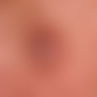 Keratoakanthoma, classic type:hard, reddish-brown, reddish-brown, centrally hyperkeratotic lump, ...
