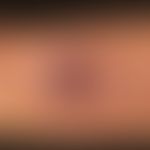 Riesenkeratoakanthom (Typ: Keratoacanthoma marginatum centrifugum):&nbsp; 73 Jahre alter Patient ...