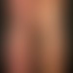 Klippel-Trénaunay syndrome: extensive, bilateral vascular malformation of capillary (naevus flamm...