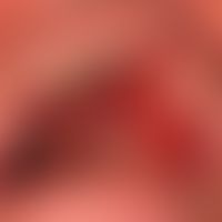 Contact allergy, contact allergic mucositis: pronounced, sharply defined contact mucositis on pro...