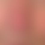 Squamous cell carcinoma of the skin: slowly growing, non-sensitive fleshy lump, first manifested ...