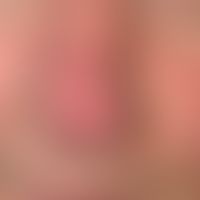 Squamous cell carcinoma of the skin: slowly growing, non-sensitive fleshy lump, first manifested ...