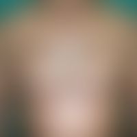 Keloid:large, brown to brown-red, very coarse, stripy, smooth knot with a sharp edge structure; n...