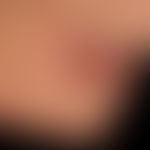 Skin metastasis: Metastasis of a previously known squamous cell carcinoma of the floor of the mou...