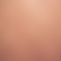 Koebner phenomenon in reactive, perforating collagenosis; striped arrangement of the papules afte...